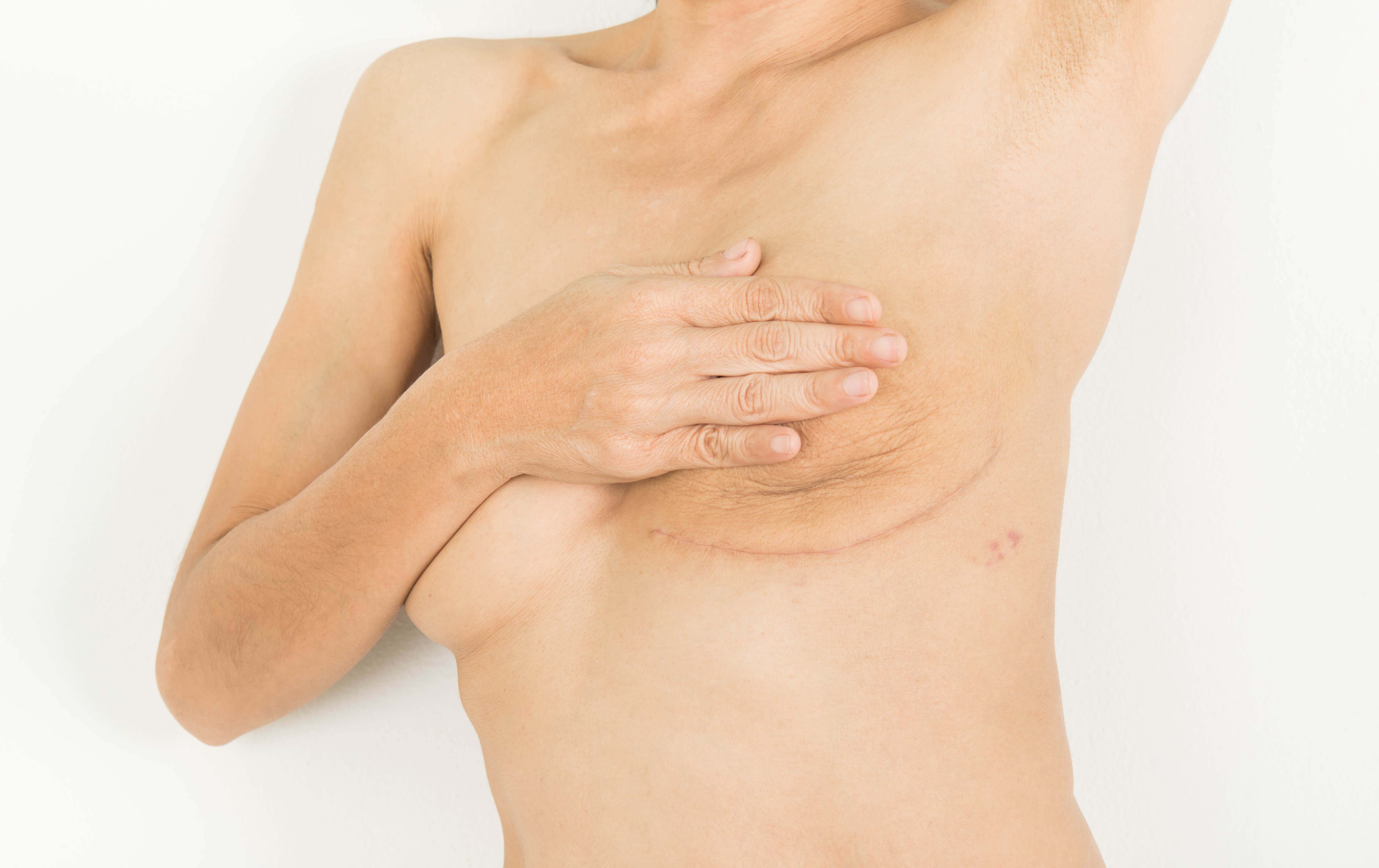 The movement of going flat after a bilateral mastectomy.