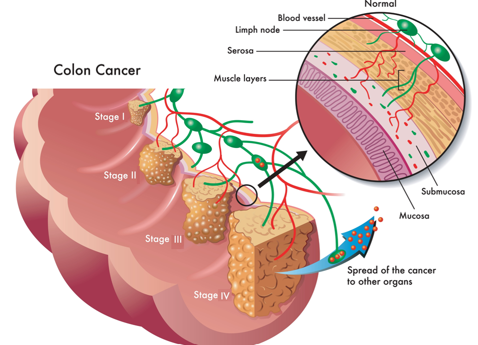 Illustration  of the stages of colon cancer